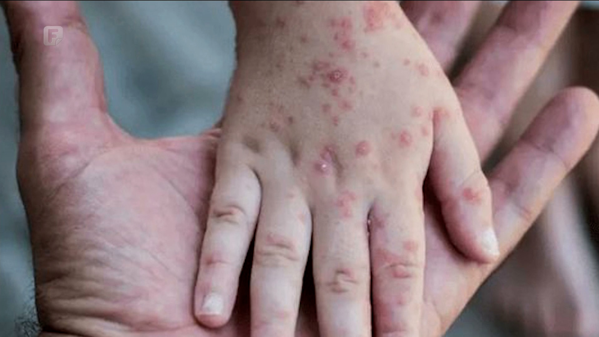 Majmunske boginje - kako se prenosi bolest, liječi i kako je prevenirati?